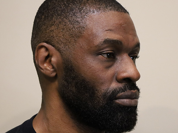 Rhinoplasty Patient 48 Before 1