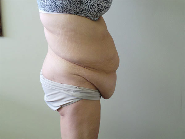 Tummy Tuck Patient 11 Before 1