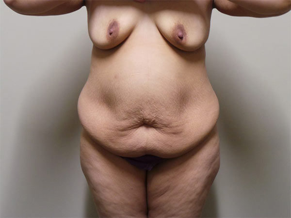 Tummy Tuck Patient 14 Before 1