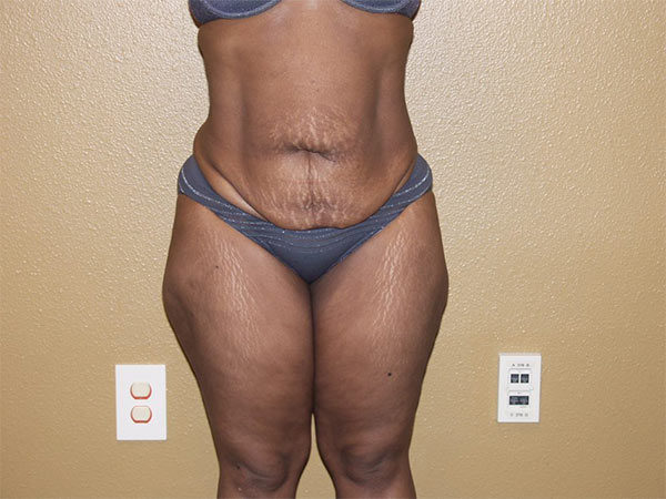 Tummy Tuck Patient 16 Before 1