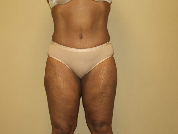 Tummy Tuck Patient 16 After 1
