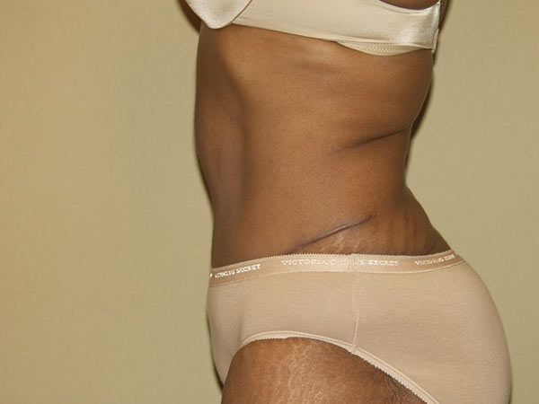 Tummy Tuck Patient 16 After 2