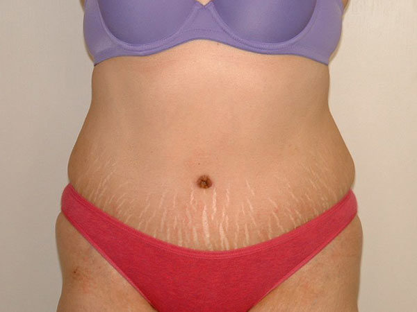Tummy Tuck Patient 17 After 1