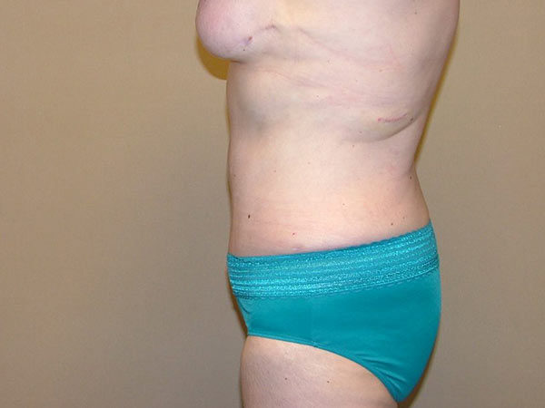 Tummy Tuck Patient 18 After 2