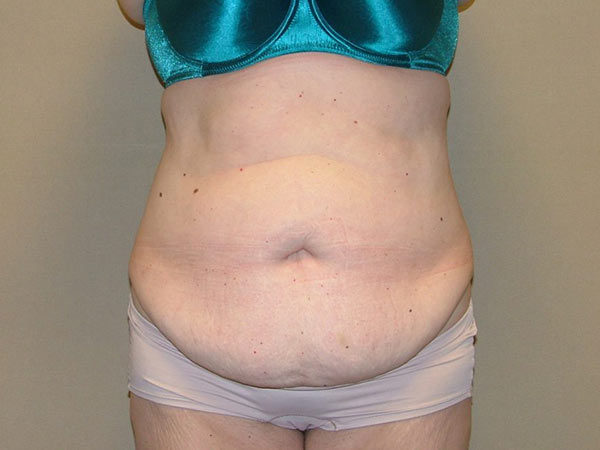Tummy Tuck Patient 18 Before 1