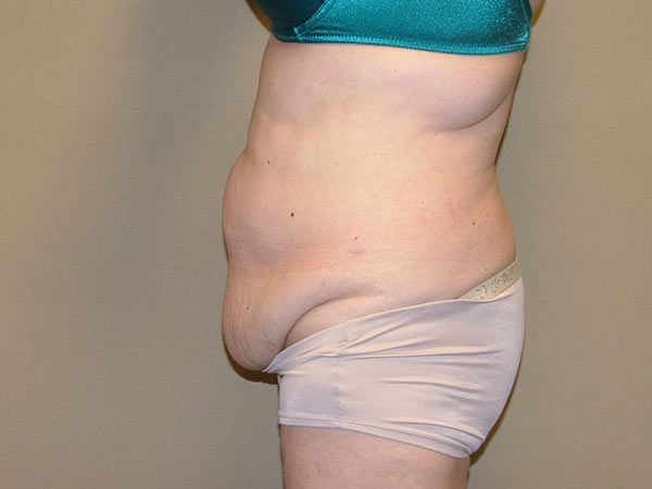 Tummy Tuck Patient 18 Before 2