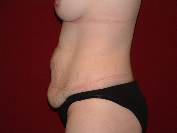Tummy Tuck Patient 19 Before 2