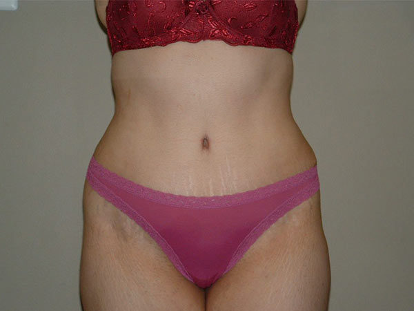 Tummy Tuck Patient 20 After 1