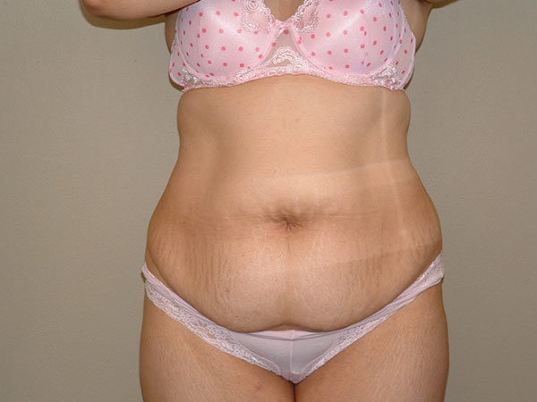 Tummy Tuck Patient 20 Before 1
