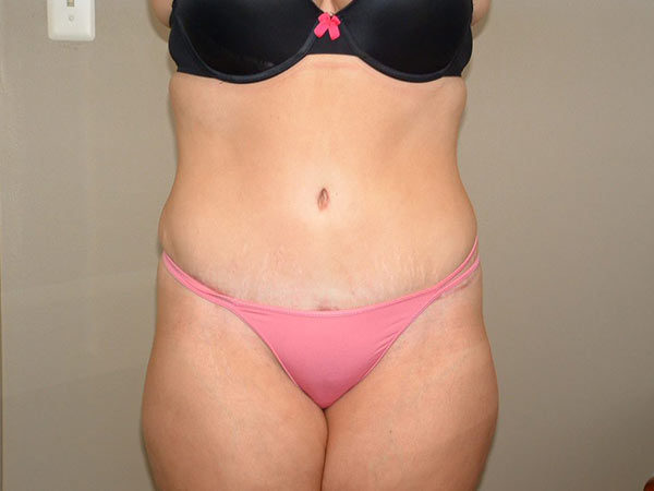 Tummy Tuck Patient 21 After 1