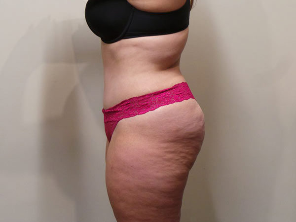 Tummy Tuck Patient 03 After 2