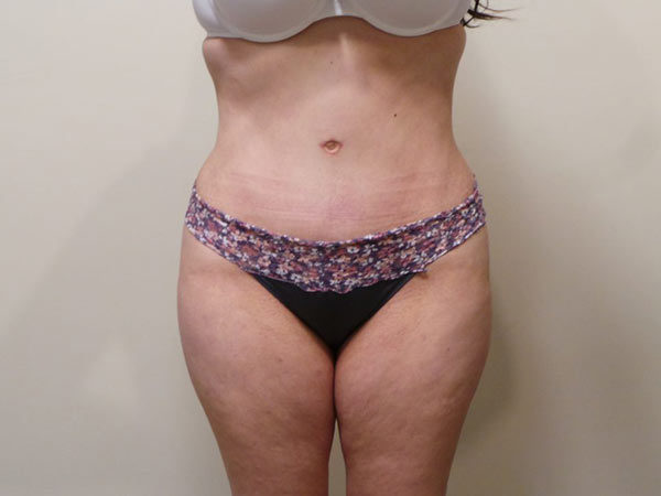 Tummy Tuck Patient 04 After 1