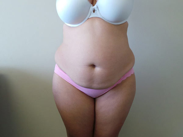 Tummy Tuck Patient 06 Before 1