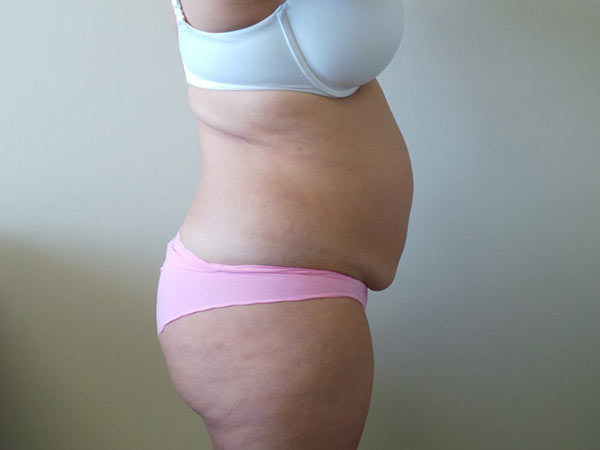 Tummy Tuck Patient 06 Before 2