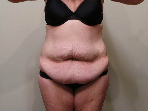 Tummy Tuck Patient 07 Before 1