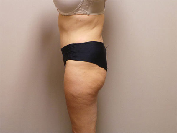 Tummy Tuck Patient 09 After 2