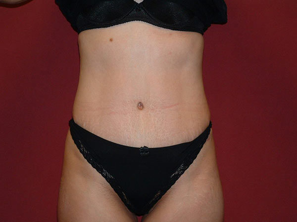 Tummy Tuck Patient 10 After 1