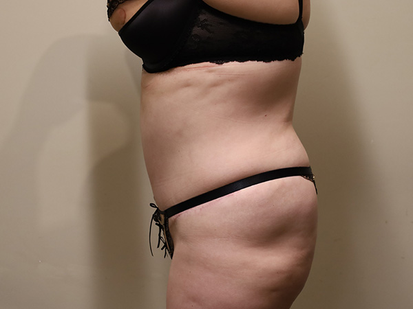 Tummy Tuck Patient 23 After 2