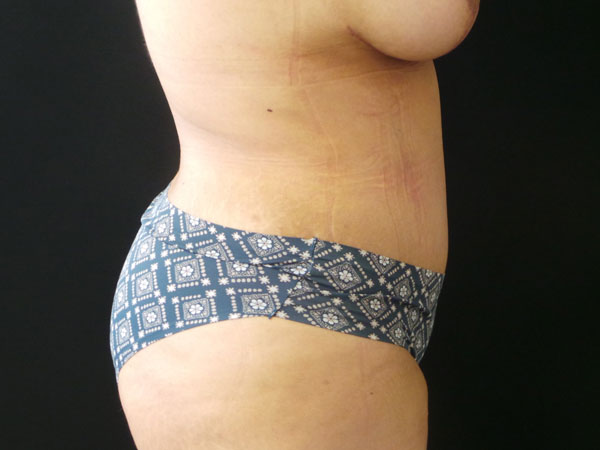 Abdominoplasty Case 25 After 2