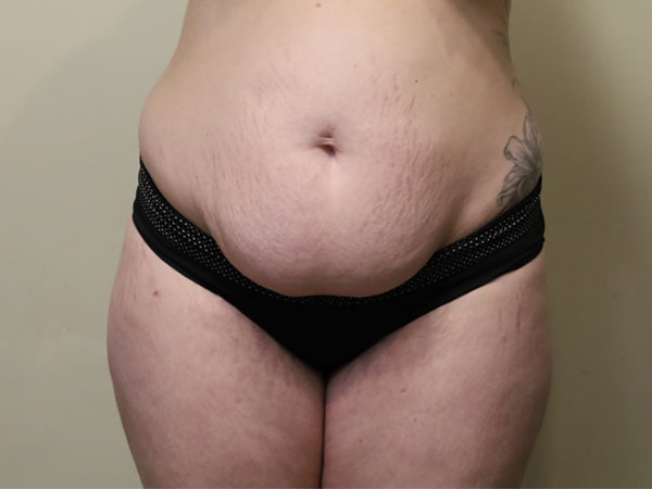 Abdominoplasty Case 27 Before 1