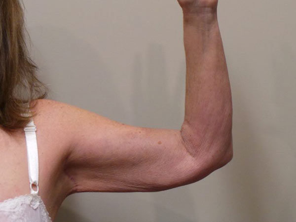 Arm Lift Patient 01 After 1