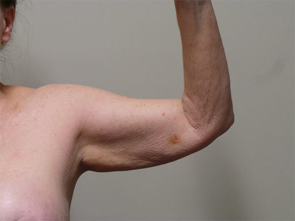 Arm Lift Patient 01 Before 1