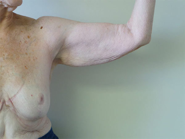 Arm Lift Patient 02 Before 1