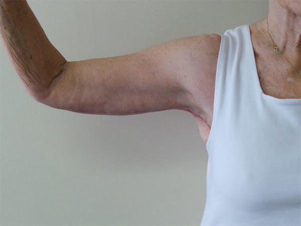 Arm Lift Patient 02 After 2