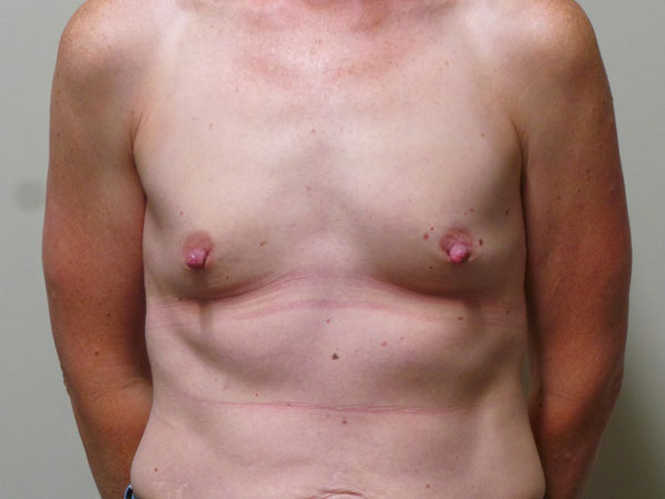 Breast Augmentation Patient 61 Before 1