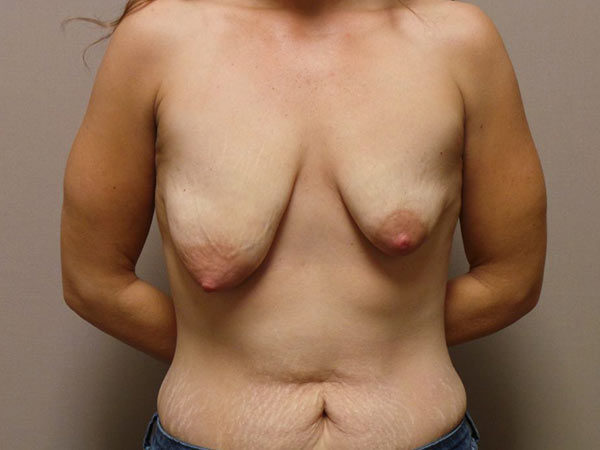 Breast Augmentation with Lift Patient 13 Before 1
