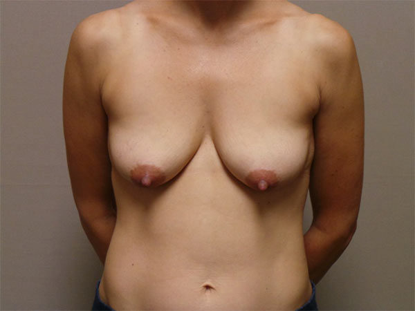 Breast Augmentation with Lift Patient 30 Before 1
