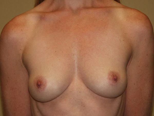 breast Augmentation Patient 34 Before 1