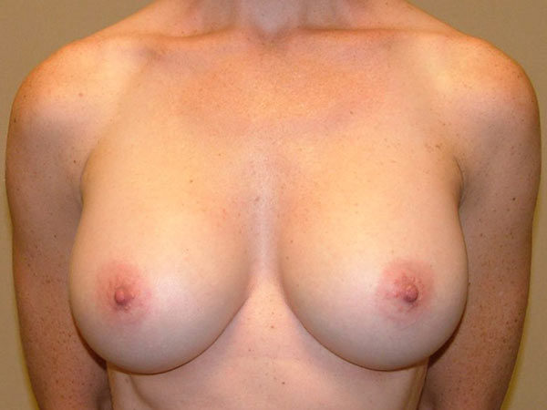 breast Augmentation Patient 34 After 1