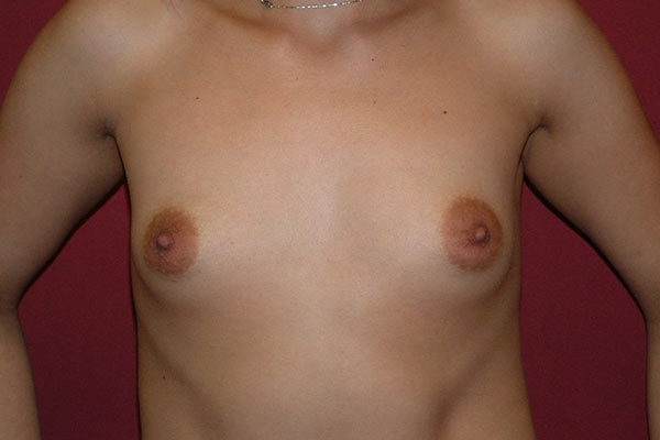 Breast Augmentation Patient 11 Before 1