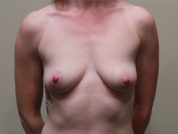 Breast Augmentation Patient 09 Before 1