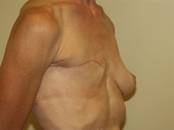 Breast Reconstruction Patient 01 Before 2