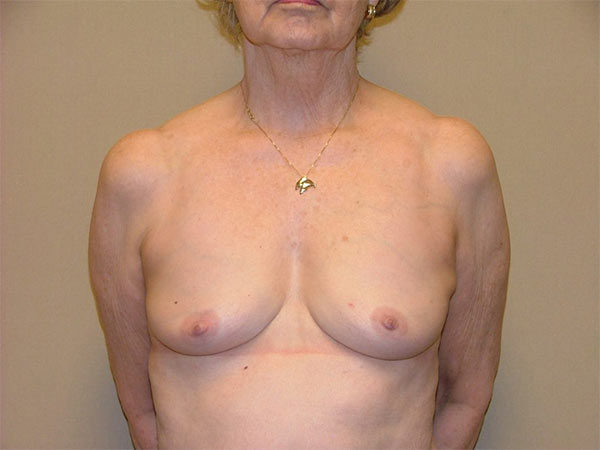 Breast Reconstruction Patient 03 Before 1