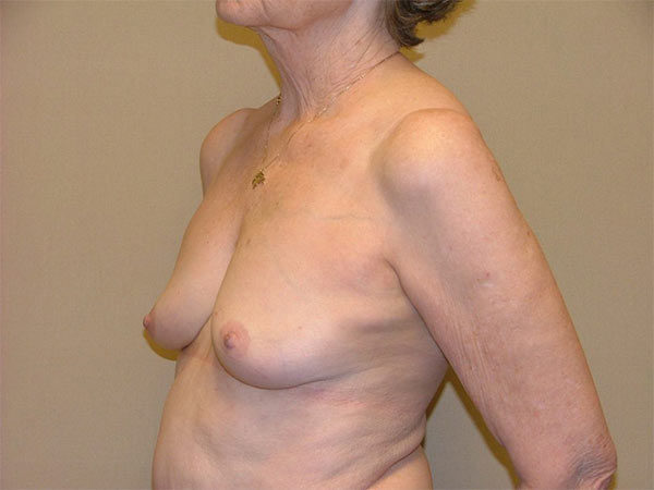Breast Reconstruction Patient 03 Before 2