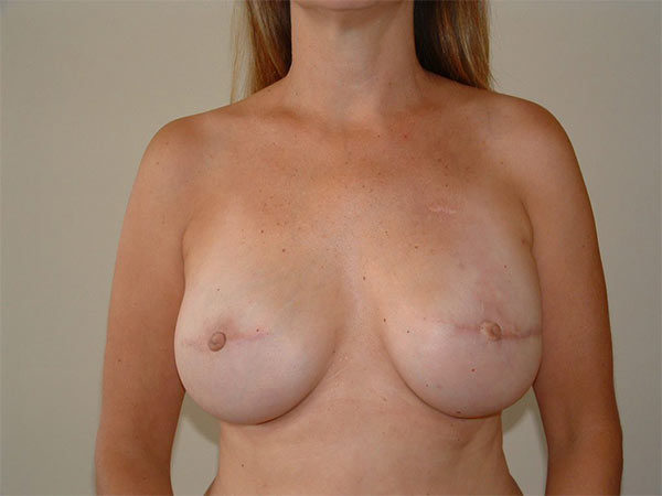 Breast Reconstruction Patient 04 After 1
