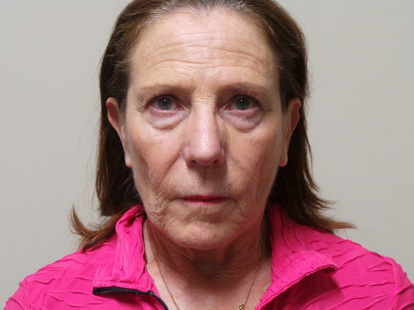 Brow Lift Patient 05 Before 1