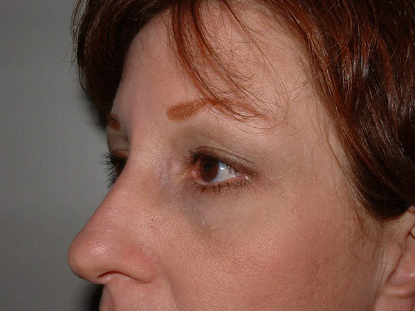 Brow Lift Patient 01 After 2
