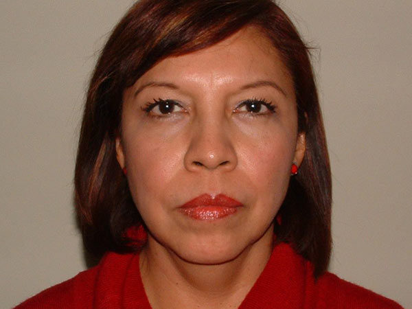 Brow Lift Patient 03 Before 1