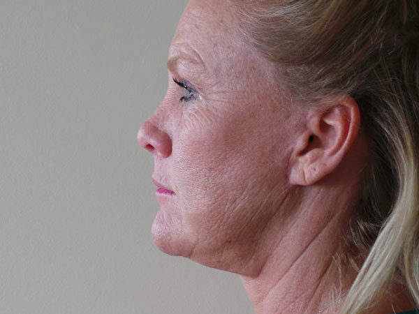 Brow Lift Patient 02 After 1