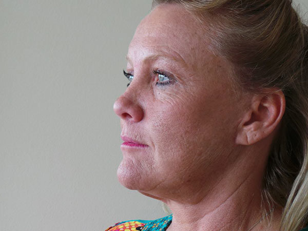 Brow Lift Patient 02 After 2