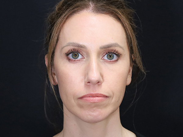 Chin Augmentation Patient 07 After 1