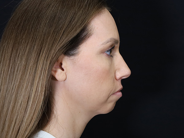 Chin Augmentation Patient 07 Before 2