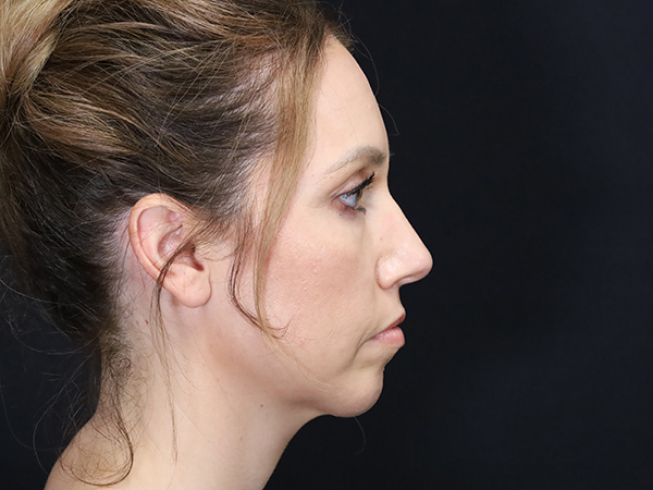 Chin Augmentation Patient 07 After 2