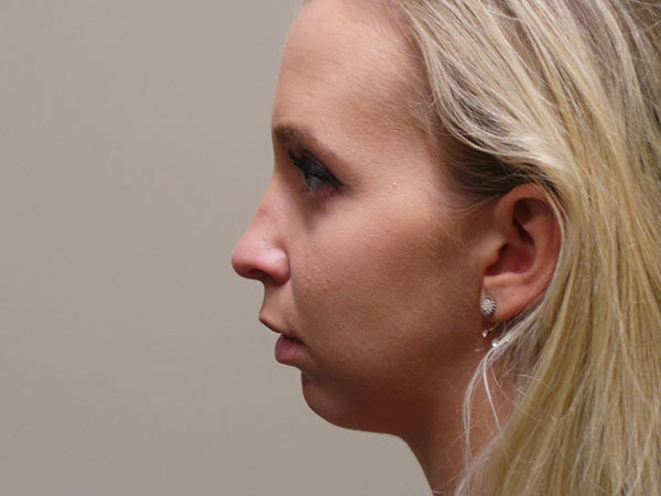 Chin Augmentation Patient 01 Before 1