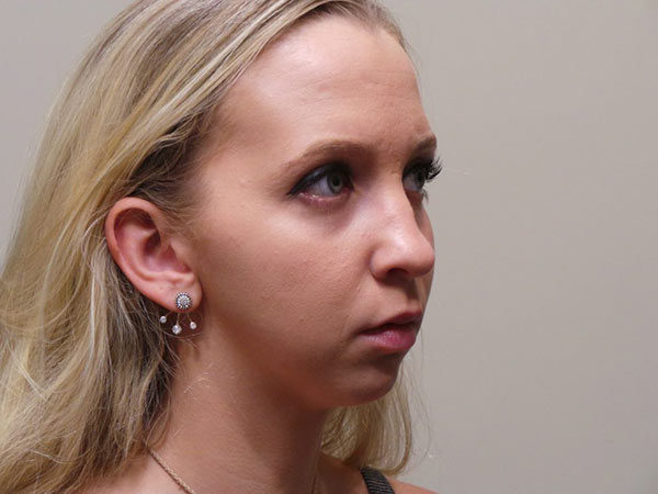 Chin Augmentation Patient 01 Before 2