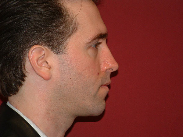 Chin Augmentation Patient 05 After 2